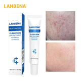 Acne Treatment Facial Mask